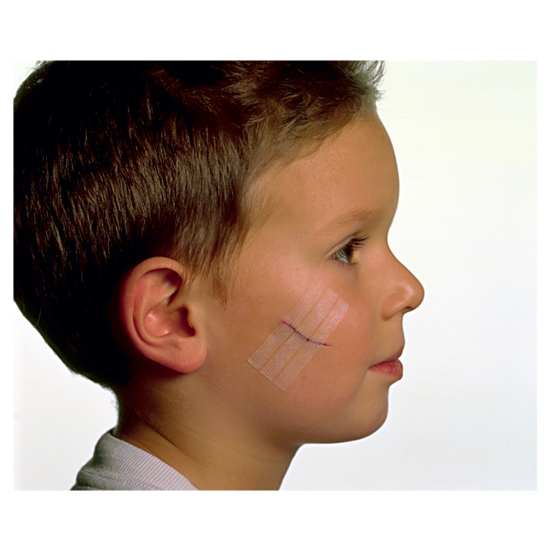 Steri Strip Paski do zamykania ran , białe: 3 x 75 mm - 5 szt. + 6 x 75 mm - 3 szt.